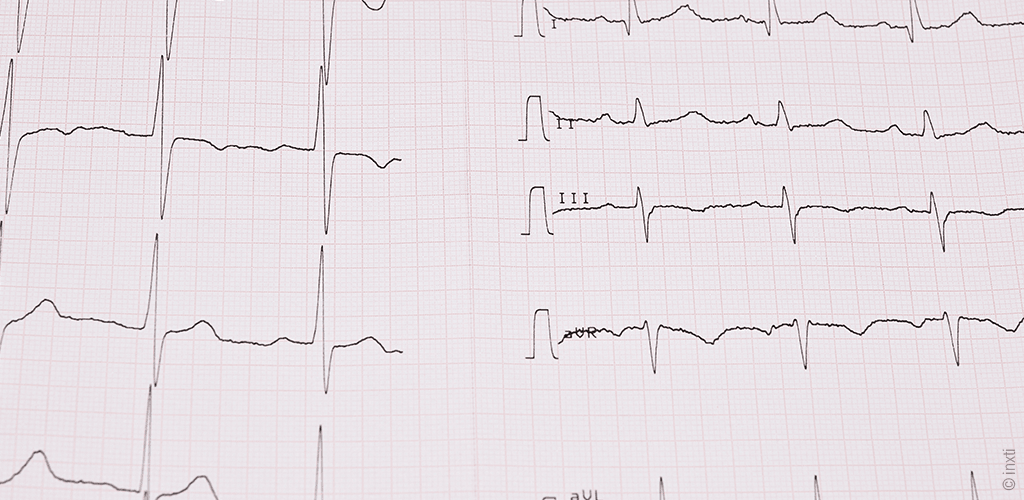 graphique fréquence cardiaque
