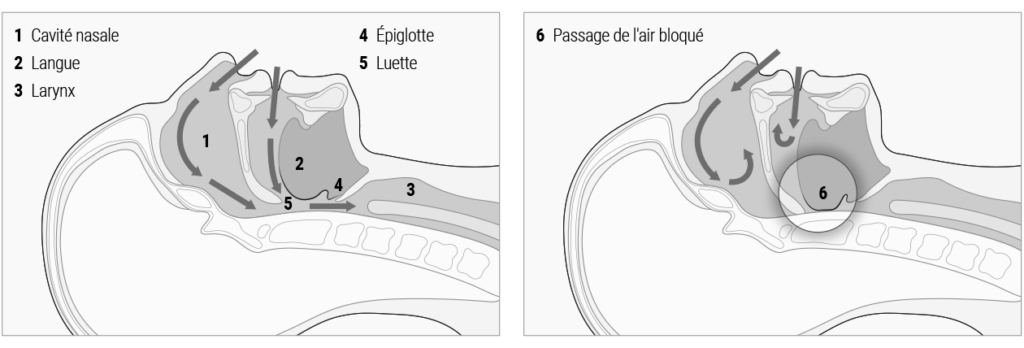 Illustration anatomique avec le texte Cavité nasale Langue, Larynx, Épiglotte, Luette, Passage de l'air bloqué